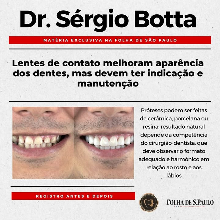 📰 Mais uma vez, nosso trabalho é destaque na Folha de São Paulo! 🙌💎
A matéria aborda as lentes de contato dentais, uma técnica que, quando indicada e mantida corretamente, transforma sorrisos com naturalidade e harmonia. 🔥
Se você busca melhorar a estética do seu sorriso de forma segura e com resultados incríveis, agende sua consulta conosco. Estamos prontos para transformar o seu sorriso! 😁✨
🔗Link da matéria: https://www1.folha.uol.com.br/equilibrio/2024/09/lentes-de-contato-melhoram-aparencia-dos-dentes-mas-devem-ter-indicacao-e-manutencao-corretas.shtml