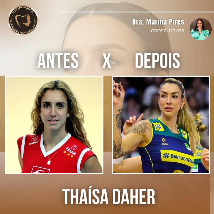 Confira o antes e depois da Thaisa Daher, atleta do Brasil, que passou por uma incrível harmonização facial. ✨
💉Com a dosagem certa, uma boa harmonização valoriza e realça os traços naturais do rosto, proporcionando um resultado harmonioso e equilibrado.
✨Na nossa clínica, priorizamos a naturalidade e a individualidade de cada paciente. A Thaísa é um exemplo de como uma abordagem cuidadosa e personalizada pode trazer um impacto positivo, destacando ainda mais a beleza única de cada pessoa.✨
#HarmonizaçãoFacial #AntesEDepois #BelezaNatural #Estética #dentista #HOF