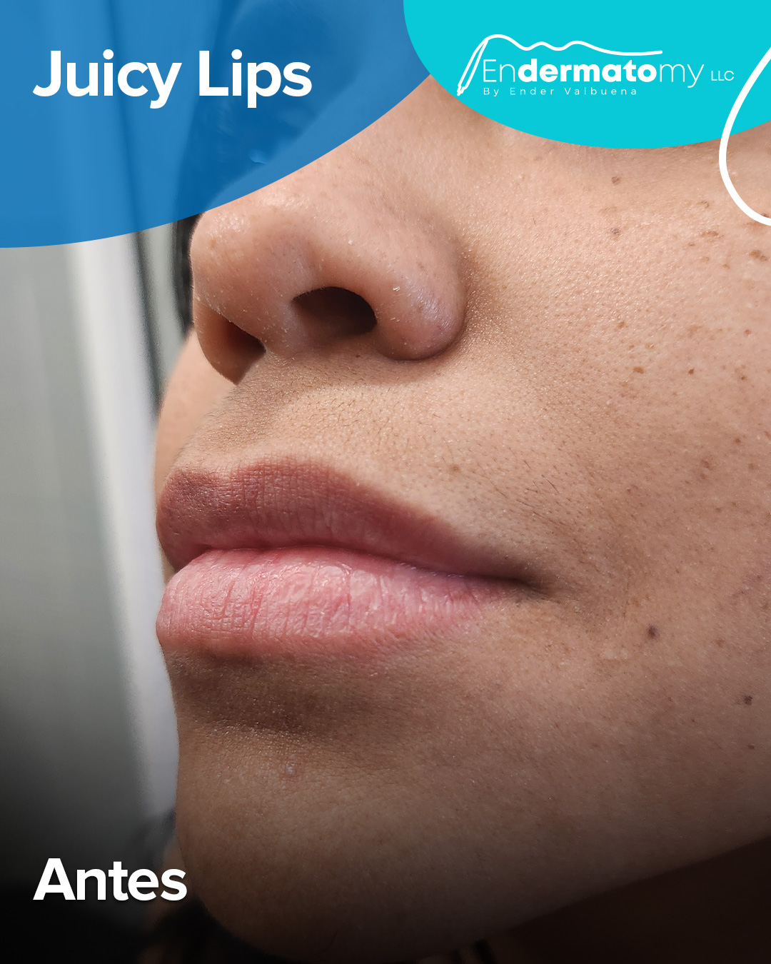 Inicia el mes luciendo unos labios jugosos y naturales con el tratamiento de Juicy Lips, procedimiento por el cual tendrás unos labios de mayor volumen, carnosos y de aspecto natural. 🌟
Agenda tu cita por el número:
📱786-930-0904
#lips #labios #juicylips #tratamiento #procedimiento #carnosos #volumen #natural