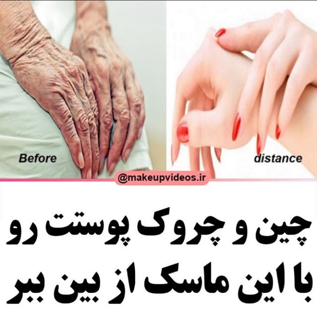اسید لاکتیک موجود در ماست می تواند رطوبت مورد نیاز پوست را تامین کند.روی موجود در آن فرآیند پیری را کندتر می کند و از چین و چروک های صورت می کاهد.کلسیم موجود در آن برای درمان پوست های خشک و پوست پوست شده مفید است.
@makeupvideos_aroos
ویتامین B5 موجود در ماست می تواند پوست های تیره را روشن تر کند و جای زخم و نقاط تیره را از بین خواهد برد. ماست حاوی ویتامین B12 است و برای روشن کردن پوست مفید است.ماست حاوی ویتامین B2 است و به رشد سلول های سالم پوست کمک می کند.ریبوفلاوین موجود در آن ، از اسیب رادیکال های آزاد به پوست جلوگیری می کند.د.
@makeupvideos_aroos
@makeupvideos_aroos
✅قبل از مصرف تست حساسیت انجام بدین.
مواد مورد نیاز برای تهیه ترکیب:
مخمر
ماست
سفیده تخم مرغ
عسل
ما رو لایک کنید و نظراتتون رو برامون بنویسید.
تهیه و دوبله توسط پیج
@makeupvideos.ir
.
Original video
https://www.youtube.com/watch?v=251PxmvvnJc