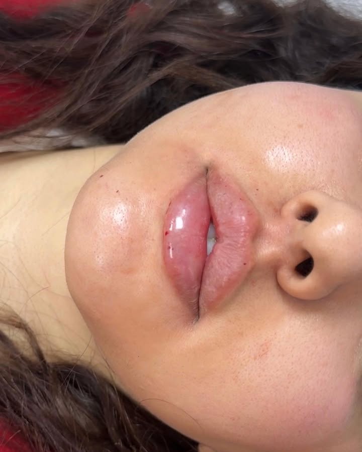 یک لب فانتزی جذاب مخصوص اونایی که خیلی نچرال هم نمیپسندن🥰
❌عزیزان هیچ دو لبی مثل هم نخواهد شد و هر لب بسته به بیس خودش تغییر خواهد کرد
❌پنجاه درصد حجم اولیه تز(یق ناشی از تورم هست و دوهفته بعد از بین خواهد رفت درصورتی که لیفت یا فرم اولیه رو میپسندید ختما باید تز(یقاتتون رو تکرار کنید
❌کارهای بدون هیچ فیل/تر یا حتی میکاپی برای شما گذاشته میشه تا شما با واقعیت کار ها اشنا باشید❤️
#لبروسی #فیلرلب #فیلرلب_طبیعی #فیلرلب_روسی #فیلرلب_فانتزی #ژللبروسی #ژل_لب_روسي #شیراز #زیبایی