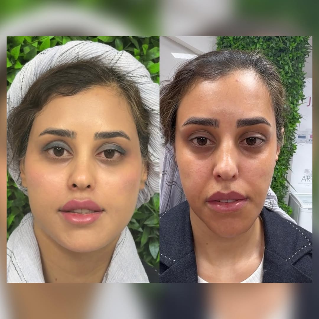 ایجاد تناسب در صورت و کاهش لاغری و خستگی تنها با تز(یق فیلر🥰
اگه میخوای بدونی کدوم نواحی تز(یق شده کلمه لاغری رو کا/منت کن😉
#فول_فیس #جوانسازی #مادلینگ_صورت #کانتورینگ #شیراز #لبروسی #فیلرگونه