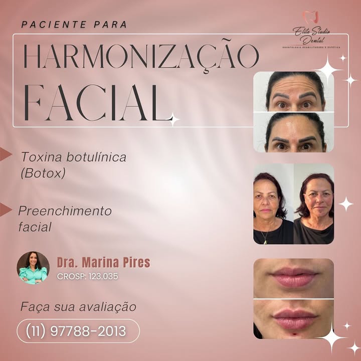 Inicie o ano dando um presente para você mesma. Faça sua harmonização com a Profa Marina, referência na área.
#preenchimentolabial #preenchimentofacial #hof #labiosperfeitos #tatuape #tatuapebairro #mooca #vilamatilde #penhasp #ipiranga #ermelinomatarazzo #itaquera #esteticafacial