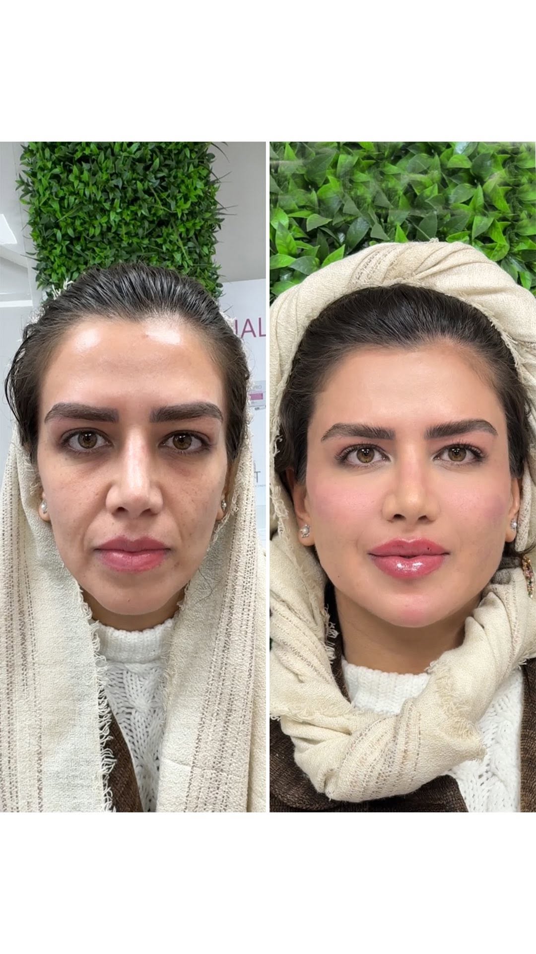 نتیجه تز(یق فیلر در صورت مراجعه کننده عزیزمون رو میبینید که باشکایت خستگی و لاغری مفرط صورت مراجعه کردن و با اینکه فقط سی سالشون بود چهرشون خسته تر میزد اما بعد از تز(یق حداقل ده سال جوانتر شدن❤️
اگه میخوای بدونی کدوم نواحی تز(یق شده کلمه (جوانی) رو کا/منت کن❤️
#مادلینگ_صورت #مادلینگ_صورت_زاویه_سازی_فک_چانه_خط_خنده_گونه #جوانسازی_صورت #شیراز #زیبایی_صورت