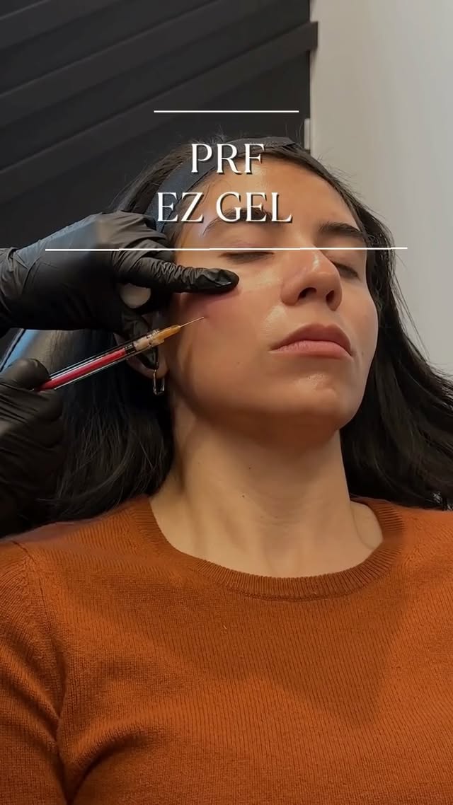 A natural boost for your skin ✨💉
PRF EZ Gel is a game-changer when it comes to anti-aging. Using growth factors from your own blood, it restores volume, repairs the skin barrier, and helps your skin regenerate for a youthful, plump complexion.
PRF EZ Gel is your ultimate solution to restore volume, reduce fine lines, and rejuvenate your skin!
No magic, just science 🔬
#austinplasticsurgeon #aps #EZgel #naturalfiller #antiaging #collagenboost #filler #medspa #atx #satx