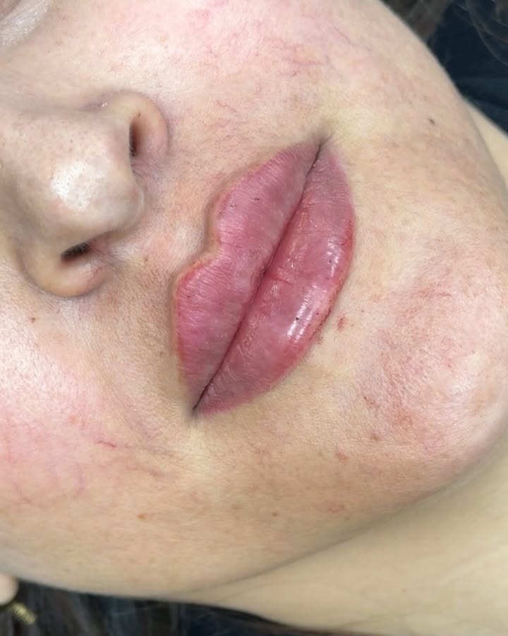 ورق بزنید✨
تزریق فیلر لب برای مراجعه کننده عزیزم🩷
( ویدیو در اسلاید دوم )
لب در نمای نیم رخ کاملا تخت هست🌸
_____________________________
آدرس : قدوسی غربی ، ساختمان هرمس
برای رزرو نوبت با شماره های زیر تماس بگیرید👇🏻
09332807168
09371010024
____________________________
#فیلرلب_روسی #پزشک_زیبایی #لب_روسی #تزریق_فیلر #فیلرلب