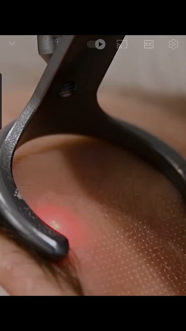 Fractional laser exclusively available at Sculpture clinic been used in aesthetic medicine since 2004. It works on the principle of selective photothermolysis to stimulate collagen production. There are two main types: CO2 (10,600 nm wavelength).
It helps reduce wrinkles, acne scars, hyperpigmentation, stretch marks and sun damage.
#askdrmaged
#sculptureclinic #plasticsurgery #beauty #aesthetics #cosmeticsurgery #doctor #egypt #fractionallaser