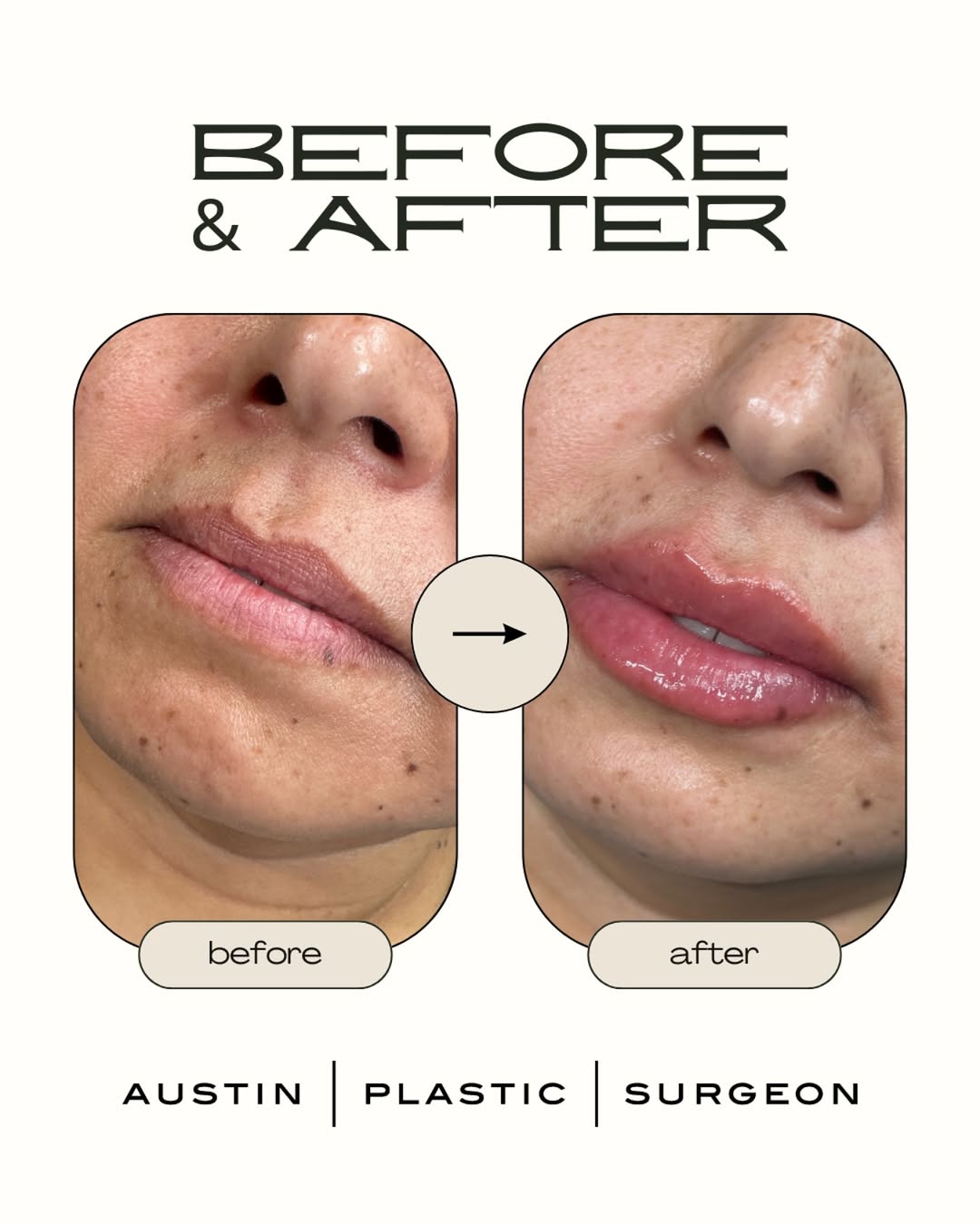 First-time lip filler never looked this good! 😍💉👄
Nurse Kim used RHA 2 to give this beauty a natural, sexy plump that’s absolutely gorgeous. Subtle enhancement, stunning results!
Been thinking about lip filler? Give us a call to book today!
#austinplasticsurgeon #aps #lipfiller #subtleplump #perfectpout #RHA2 #lipenhancement #atx #satx