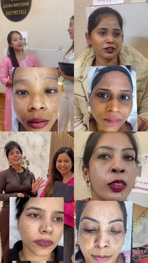 Herbal Treatment Bookings Open ☎️
Call us now
8750235045
8826867065
8368468571
8882725710
Advanced Herbal Skin Treatment :
The one stop destination for lightening & clear skin ✅
Lasting Impression Aesthetics
Our herbal Skin Treatment is 100% Safe!
❌No side effects!!
Get rid of :
Cystic Acne
Atrophic Scars
Deep Scars
Pigmentation
Dark circles
Acne spots
Dull skin
Tan skin
Dark skin
Loose skin
Melasma spots
Blemish
One time treatment!
No sittings required. It's Permanent skin lightening
#melasma#openpores#beautifulskinforlife#herbaltreatment #skincareroutine#skinlightening#acneproblems #acnemarks#pigmentation#trendingreelsvideo❤️😍👩❤️🔥🔥🔥🎥