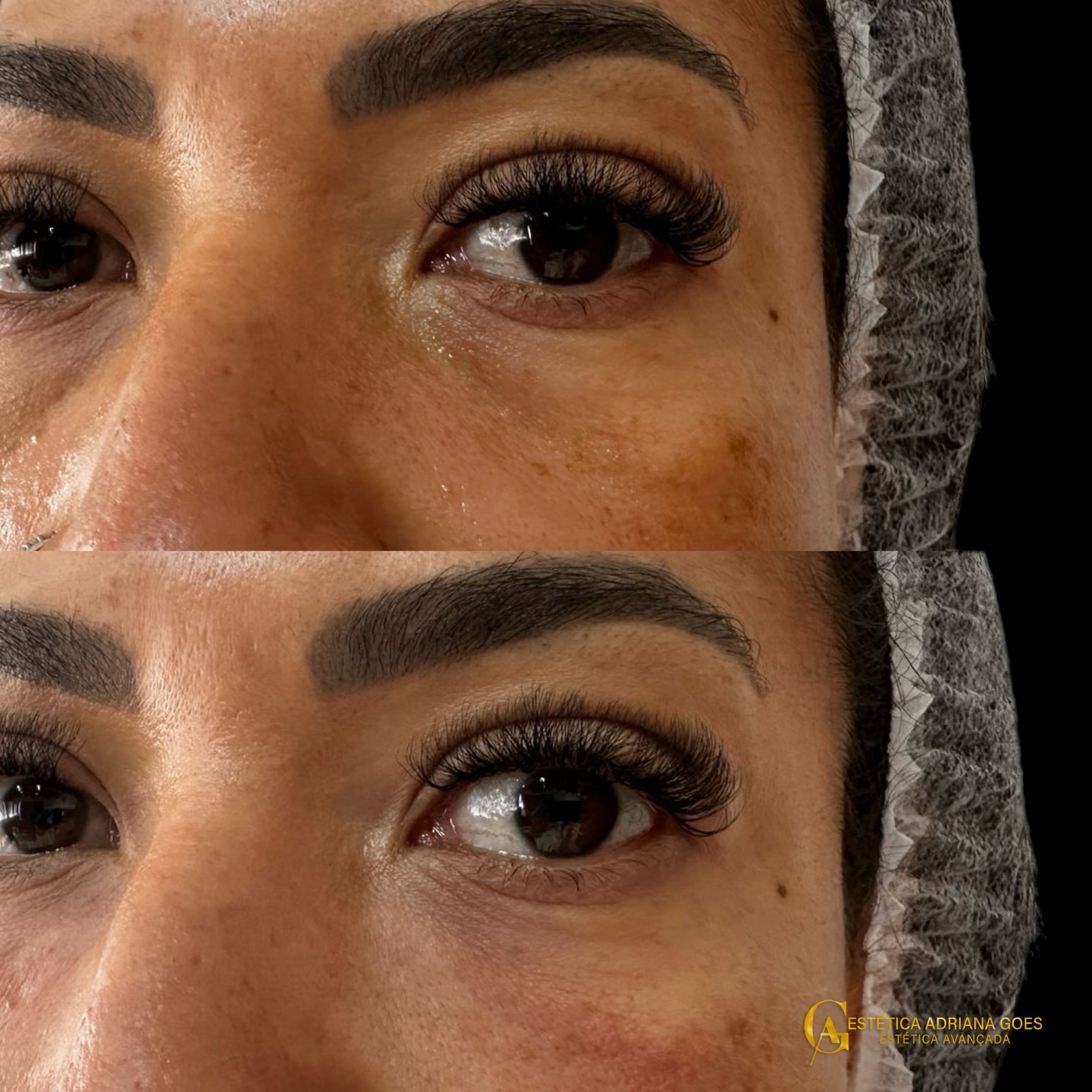 Olheiras? Nunca mais! ✨ Com o preenchimento certo, o olhar fica mais descansado e iluminado. Agende uma consulta e realce sua beleza!
(11)97496-1006
Rua Otávio Mendes, 27 sala 03
Centro
Francisco Morato/SP
@dra.fernanda_giovanini
.
.
.
.
.
.
#criolipolise #depilacaoalaser #massagem #limpezadepele #botox #preenchimento #celulite #gorduralocalizada #estetica #franciscomorato #harmonizacaofacial