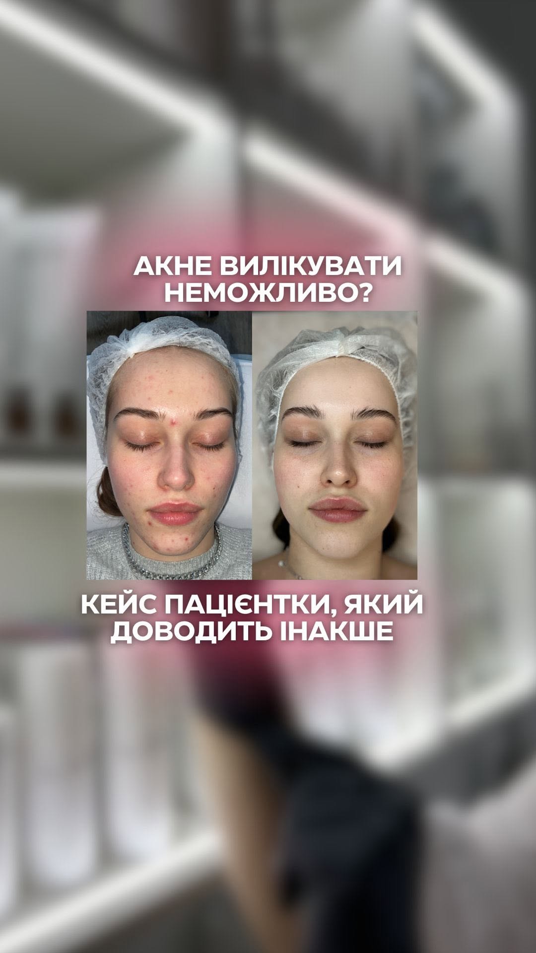 Проблемну шкіру потрібно лікувати, а не маскувати! 😌✨
Тонни тонального крему, щільні консилери, фільтри в соцмережах… Але все це – лише тимчасове рішення. Насправді проблемна шкіра потребує не маскування, а грамотного догляду та лікування.
Акне, висипання, жирний блиск, запалення – це не вирок! 🔥 Головне – знайти причину та підібрати правильний план лікування. І ми знаємо, як це зробити! 💆♀️
Записуйся на консультацію – підберемо індивідуальний план, який дійсно працює! 💖
📩 Пиши в дірект