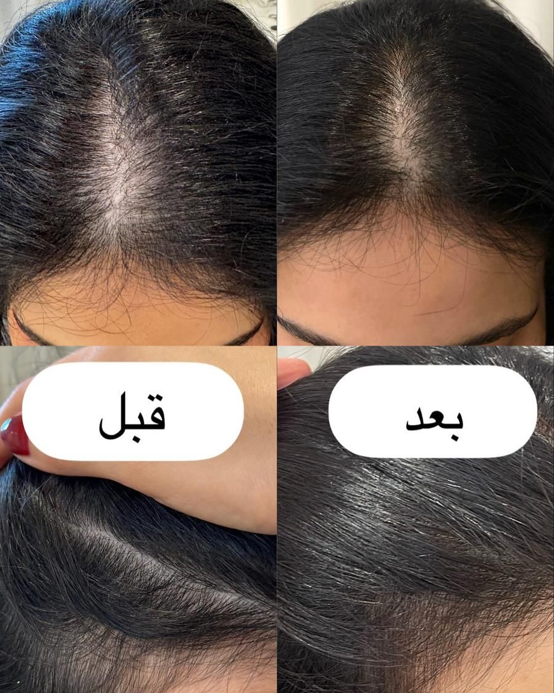 كورسات تنبيت الشعر مع لطيفة الزبن
نتايج الكورس فورية ويبين معاكم الفرق من أول جلسة