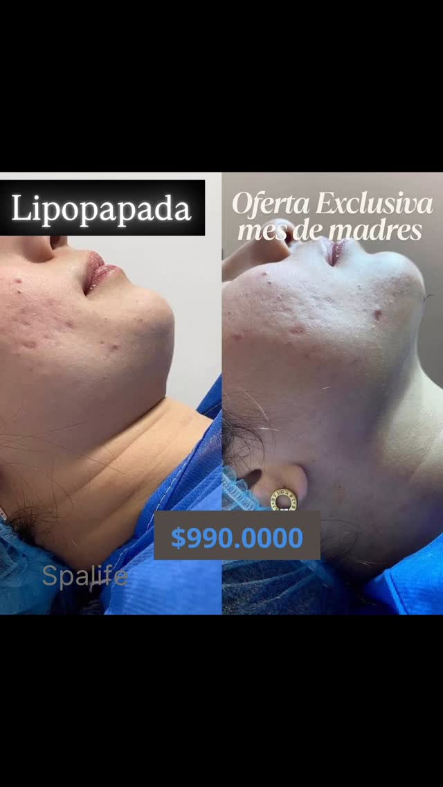 💕💕Oferta hasta el 30 de mayo !!!
Incluye mentonera
Drenajes
#lipopada #papada