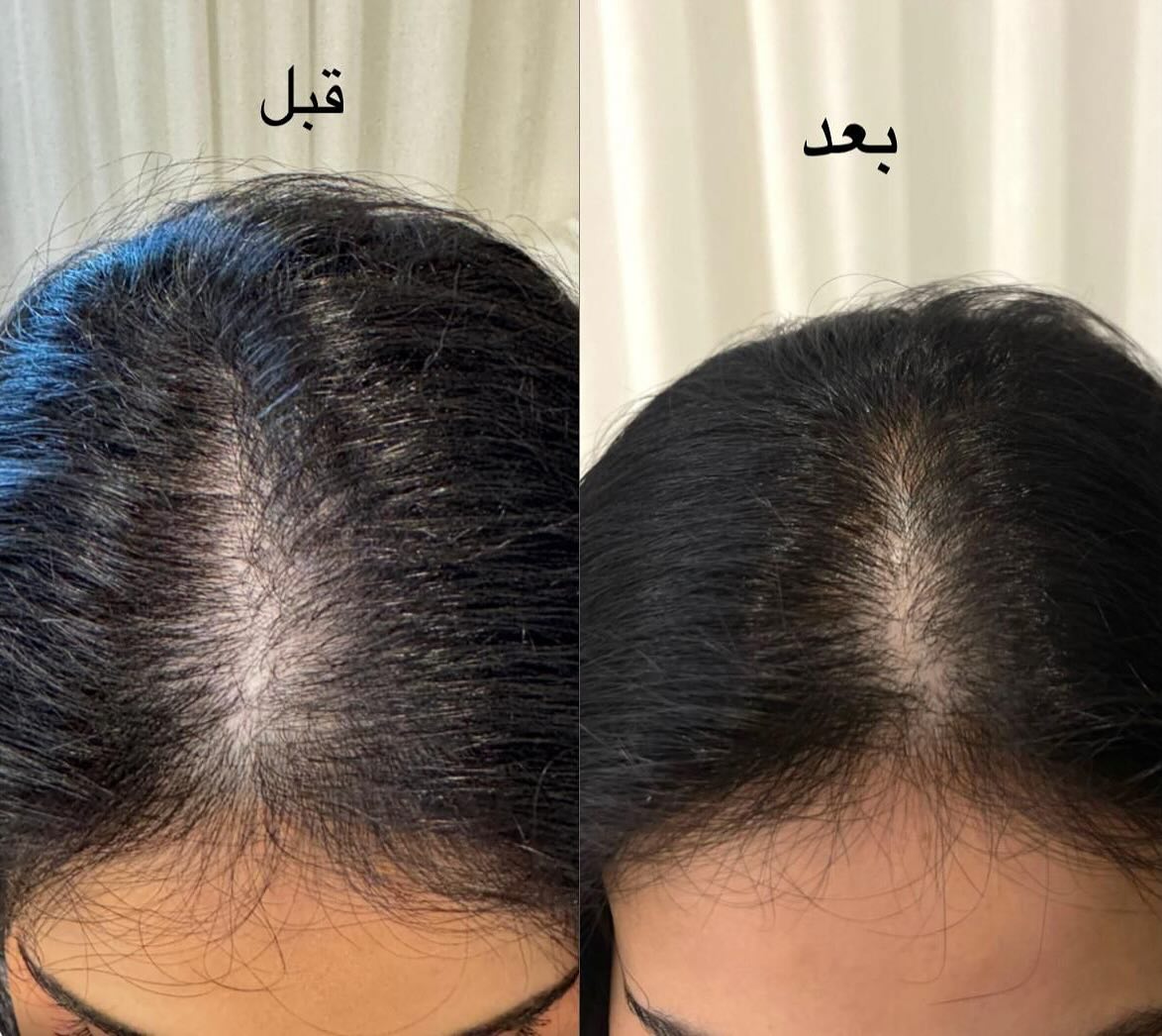 كورسات تنبيت الشعر مع لطيفة الزبن
نتايج الكورس فورية ويبين معاكم الفرق من أول جلسة
