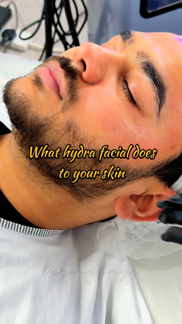 What hydra facial does to your skin
#hydrafacial #skin #magic #skincare #aesthetics #skincareroutine #pigmentation #kensalgreen #amazing #uk #london #uk #londonlife