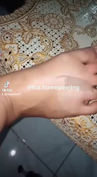 Sudah coba berbagai macam lotion gak putih putih? saatnya coba TCA peeling say, berfungsi mengelupas sel kulit mati, kulit hitam jadi putih, menghaluskan kulit, mengilangkan bekas luka, peremajaan sel
Konsul & Order ?
👇👇
DM dan WA +6285200 696867 ( FAST RESPON )
NO CALL 📵
#tca #tcapeeling #peeling #peelingmurah #peelingaman #tca35% #tcaaman #pemutih #pengelupasanbadanaman #bengkulu #palembang #kupang #bengkulu #ntt #aceh #tcaaman #bekasi #bekasi #bekasihits #cilegon #peelinggelmurah #peelingbadan #peelingwajahdokter #carapakaipeeling #sulawesiselatan #sulawesitenggara #sulawesi