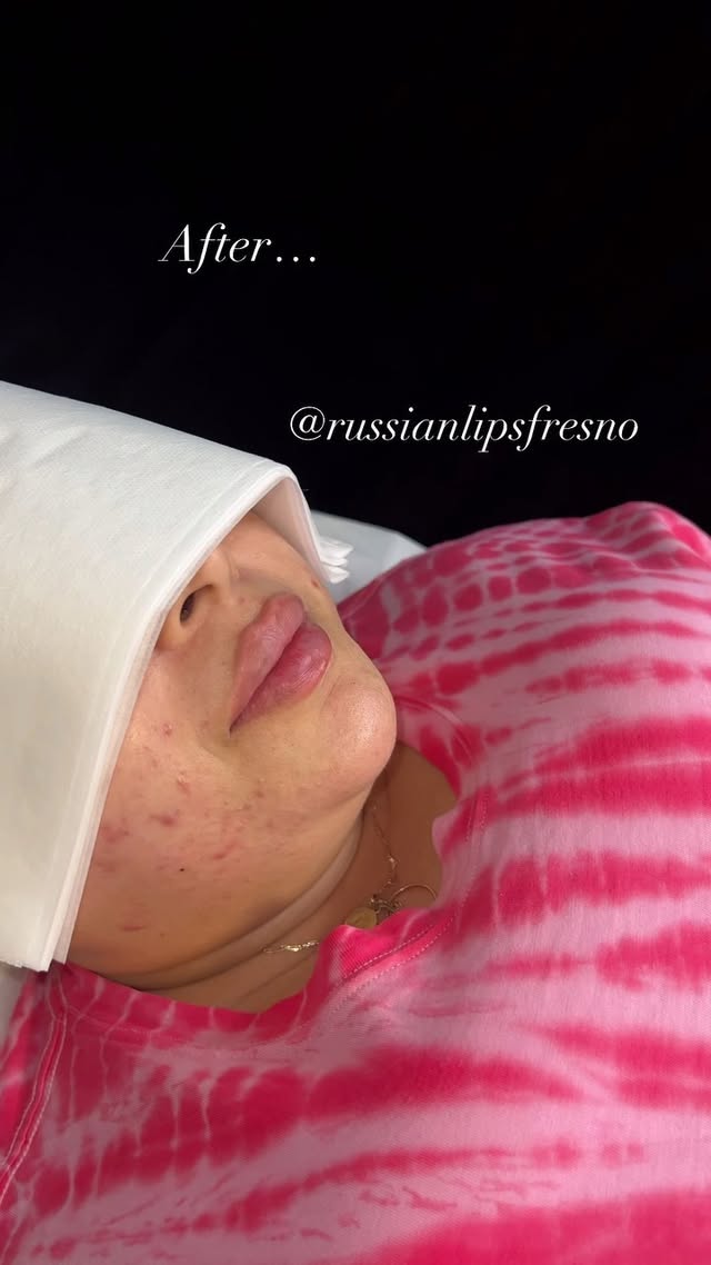 100% Customized Russian Lip Filler💋
What do you think of this customized pout.🥰
❌No Filter, Raw Process and Results😍
*Swelling will go down within the next few days
*Healing process is 2 weeks
Russian Lip Fillers💉
@russianlipsfresno
100% Customized based on each client’s desired outcome.
Thank you to our beautiful client for giving consent to share❤️
📲To book an appointment: DM US with your Full Name, Service and Phone #
🖤NYC - Open
🖤Fresno - March 23-24
🖤Los Angeles - Waitlist
✔️Book in Advance to avoid disappointment💋