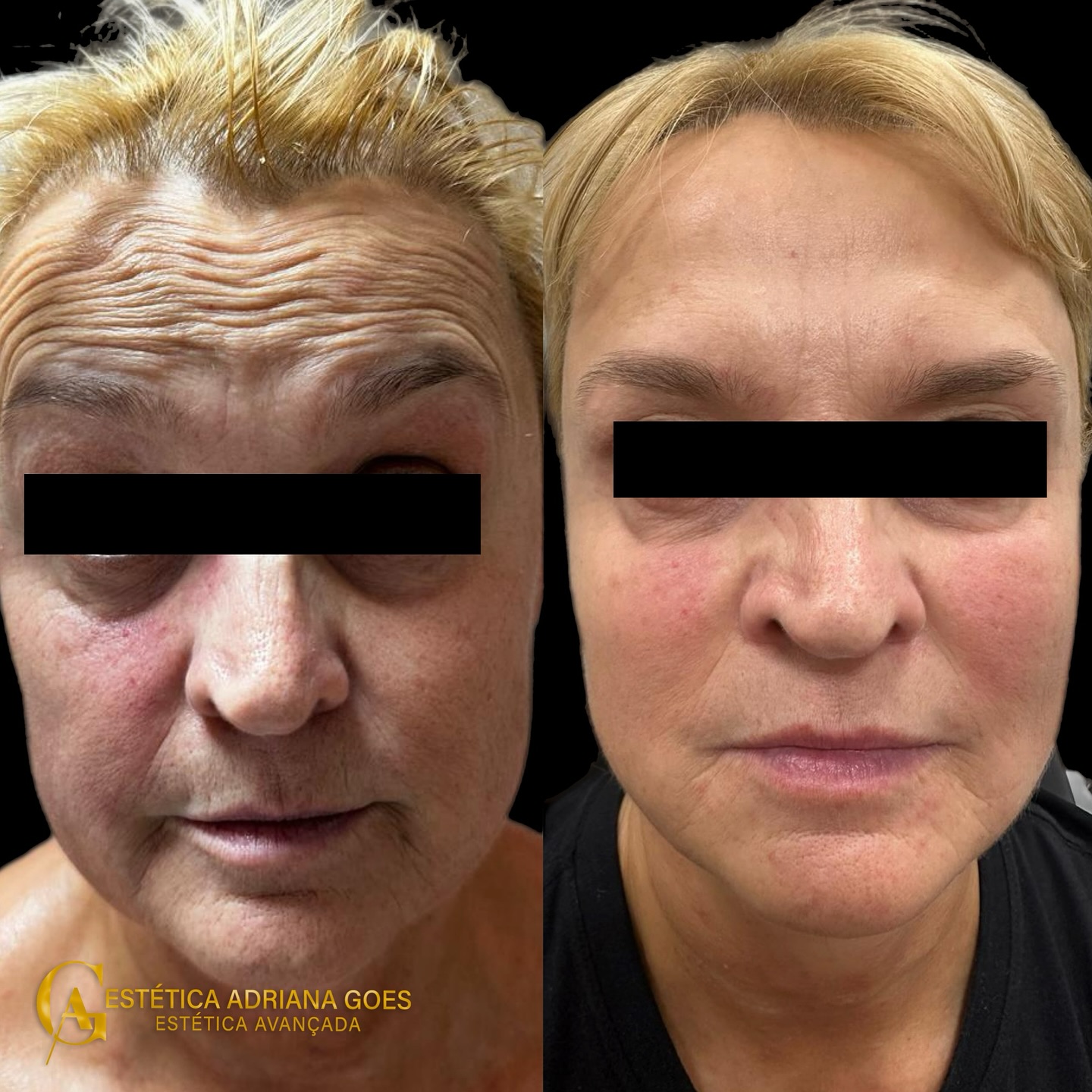 ✨Transformação com toxina botulínica!
Menos rugas, mais firmeza e um olhar mais leve.
Seu rosto merece esse cuidado! 💛💉
Agende seu horário!
(11)97496-1006
Rua Otávio Mendes, 27 sala 03
Centro
Francisco Morato/SP
.
.
.
.
.
.
#criolipolise #depilacaoalaser #massagem #limpezadepele #botox #preenchimento #celulite #gorduralocalizada #estetica #franciscomorato #harmonizacaofacial