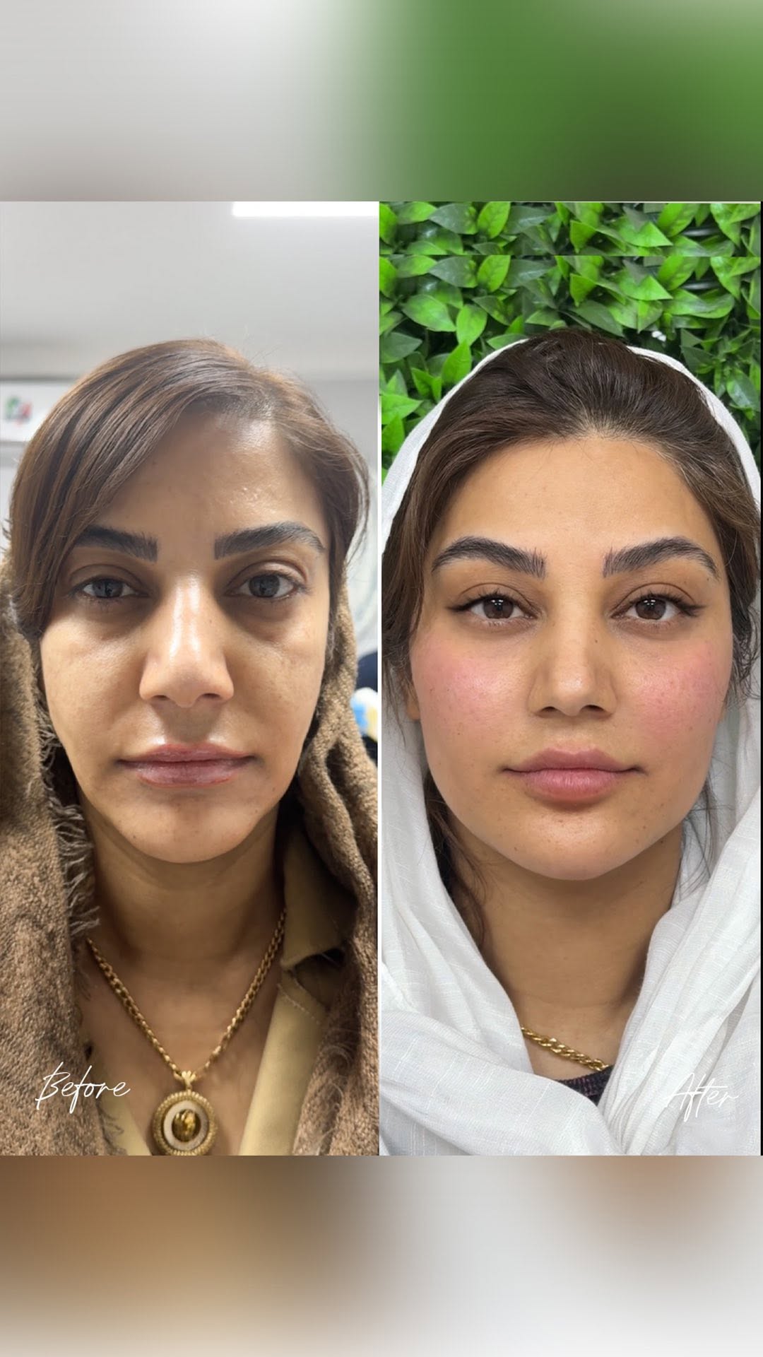برای مراجعه کننده عزیزمون طی سه مرحله کانتورینگ کامل صورت یا همون فول فیس انجام دادیم که باعث جوانتر شدن و زیباتر شدن کادر صورتشون شده…خیلی ها میپرسن فول فیس یعنی چی اگر میخوای مفهموم واقعی تز(یقات فول فیس رو بدونی کلمه (فول فیس) رو واسم کام/نت کن❤️
#مادلینگ_صورت #شیراز #کانتورینگ_صورت #فیلرصورت #زیبایی_شیراز #جوانسازی_صورت