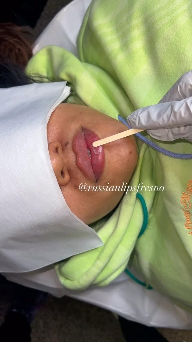 100% Customized Russian Lip Filler💋
What do you think of this customized pout.🥰
❌No Filter, Raw Process and Results😍
*Swelling will go down within the next few days
*Healing process is 2 weeks
Russian Lip Fillers💉
@russianlipsfresno
100% Customized based on each client’s desired outcome.
Thank you to our beautiful client for giving consent to share❤️
📲To book an appointment: DM US with your Full Name, Service and Phone #
🖤NYC - Open
🖤Fresno - February Sold Out
🖤Los Angeles - Waitlist
✔️Book in Advance to avoid disappointment💋