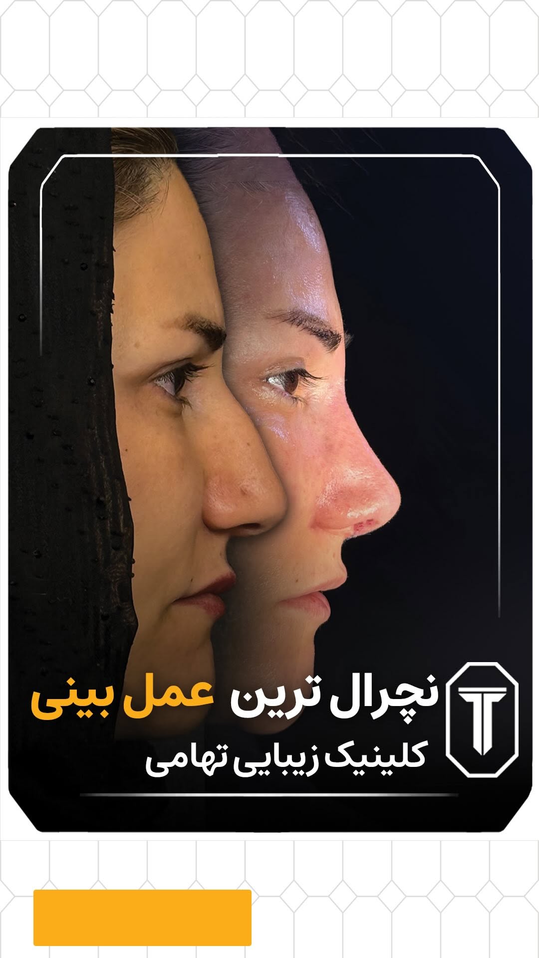 بینی خوشفرم، بدون بیهوشی🤔 بدون تامپون🧐
آره! اینجا دقیقا درباره تیپ پلاستی صحبت میکنیم!
اگه از فرم نوک بینیت راضی نیستی ولی از فکر جراحی کامل، بیهوشی و نقاهت طولانی وحشت داری…
تیپپلاستی یه راهحل کمتهاجمی و نچراله که میتونه ظاهرتو بدون دردسر تغییر بده!
چه مزایایی داره؟
• انجام در کمتر از ۱ ساعت
• بدون بیهوشی عمومی
• بدون تامپون
• ظاهر کاملاً طبیعی
• تنفس راحتتر
• و دوران نقاهت فوقالعاده سبک
سوالی داری؟ همینجا بپرس
یا برای رزرووقت مشاوره با متخصصین ما
کلمه تیپ پلاستی رو برامون کامنت کن👇🏼
تو هم حاضری بینیتو آسونتر از چیزی که فکر میکردی تغییر بدی؟
📍 آدرس: تهران، جردن
📞 مشاوره و نوبتدهی: 09120169617 | 71031-021
#تیپ_پلاستی #تیپ_پلاستی جراحی_بینی_بدون_بیهوشی #بینی_نچرال #جراحی_بدون_تامپون