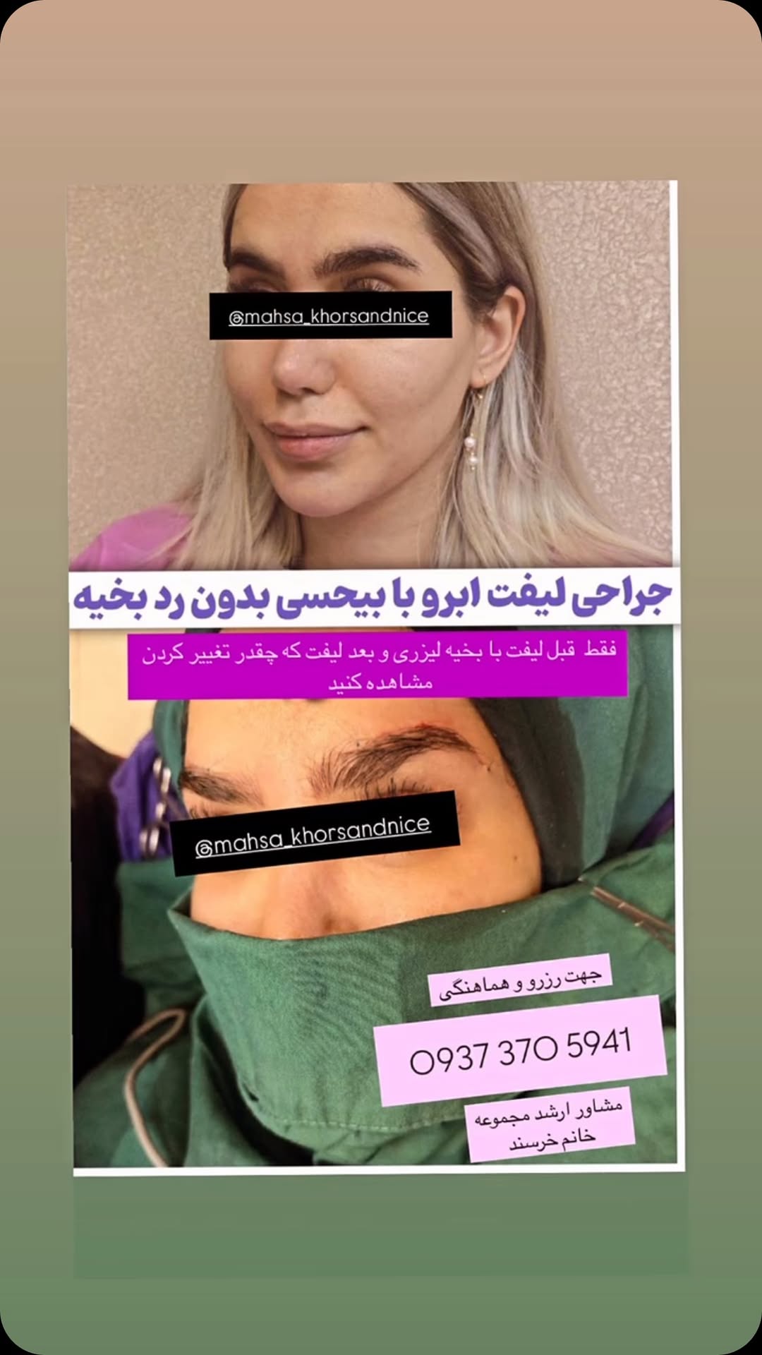 😍😍متد جدید جراحی لیفت ابرو لیزری😍😍
جهت مشاوره و هماهنگی با من هماهنگ کنید از طریق واتساپ
0937 370 5941
#معرف#مشاور#ارشد #مجموعه#تیم#خرسند #خرسندی
@mahsa_khorsandnice @mahsa_khorsandnice