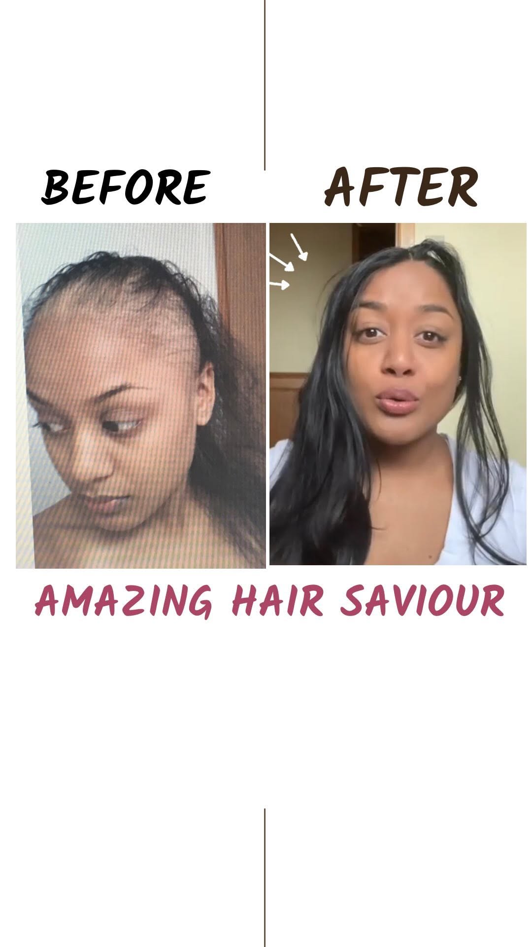Her journey is truly inspiring and one that will motivate you 😘 I hope you’re inspired! ❤️ and she’s so brave ❤️
Remember it’s about consistency ❤️
www.amazinghairsaviour.com
#hairgrowth #hairgrowthoil #hairgrowthjourney #hairgrowthproducts #hairgrowthtips #alopecia #alopeciaareata #amazinghairsaviour #hairloss #hairlosstreatment #hairlosssolution #hairlosshelp #hairlossspecialist #hairgram