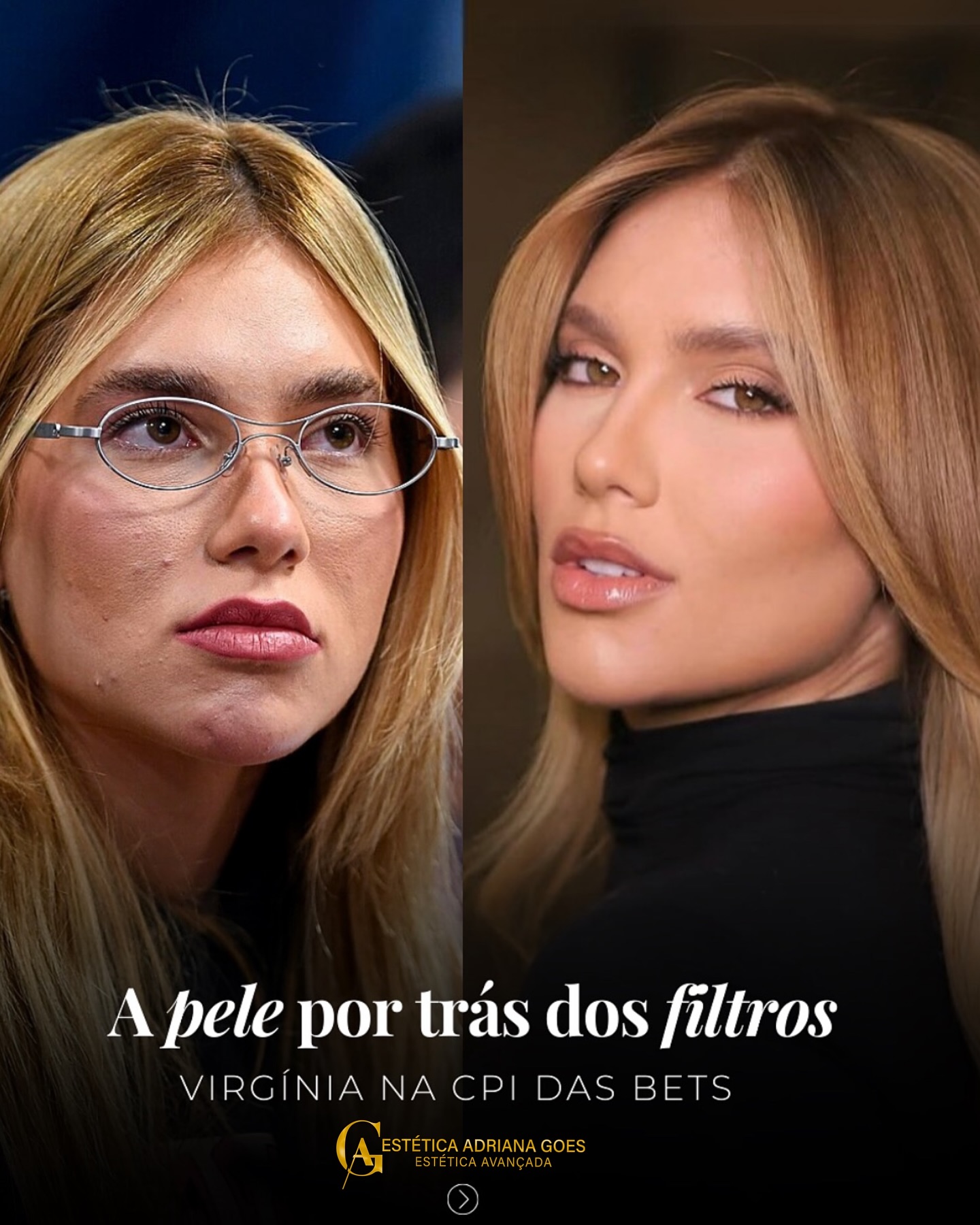 Você ainda se compara com peles editadas das redes?
Não se frustre! Agende uma avaliação gratuita e descubra o que a estética real pode fazer por você. ✨
(11)97496-1006
Rua Otávio Mendes, 27 sala 03
Centro
Francisco Morato/SP
.
.
.
.
.
.
#criolipolise #depilacaoalaser #massagem #limpezadepele #botox #preenchimento #celulite #gorduralocalizada #estetica #franciscomorato #harmonizacaofacial