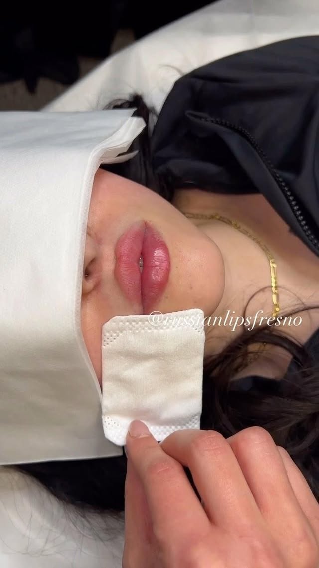 100% Customized Russian Lip Filler💋
What do you think of this customized pout.🥰
❌No Filter, Raw Process and Results😍
*Swelling will go down within the next few days
*Healing process is 2 weeks
Russian Lip Fillers💉
@russianlipsfresno
100% Customized based on each client’s desired outcome.
Thank you to our beautiful client for giving consent to share❤️
📲To book an appointment: DM US with your Full Name, Service and Phone #
🖤NYC - Open
🖤Fresno - February Sold Out
🖤Los Angeles - Waitlist
✔️Book in Advance to avoid disappointment💋