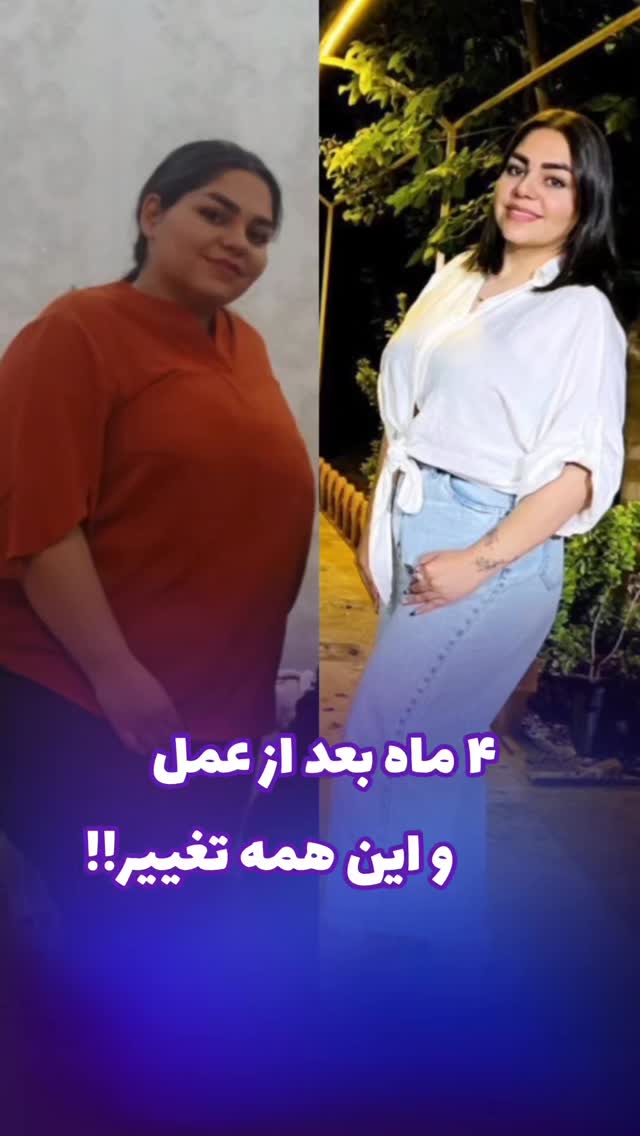 تغییرات بیمار عزیزم بعد از ۴ ماه😍
👨🏻⚕دکتر محمد عیدی متخصص جراحی عمومی و عروق فوق تخصص جراحیهای اندوسکوپی و چاقی
📍کاشان، خیابان بهشتی، بالای داروخانه قریشی، ساختمان اردیبهشت طبقه ۳
☎️ 031-55584207
🆔 @dr.mohammad.eidy
🔷🔹🔷
🌐 http://dreidy.ir/
#بای_پس#اسلیو#جراحی_چاقی#راه_حل_لاغری#جراحی_اسلیو_