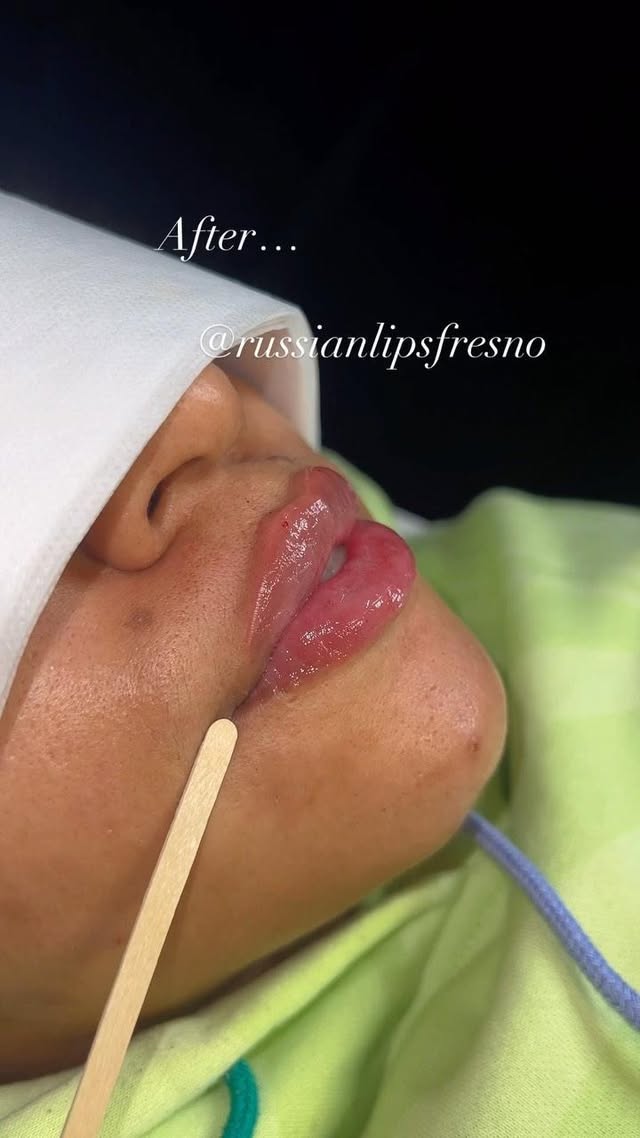 100% Customized Russian Lip Filler💋
What do you think of this customized pout.🥰
❌No Filter, Raw Process and Results😍
*Swelling will go down within the next few days
*Healing process is 2 weeks
Russian Lip Fillers💉
@russianlipsfresno
100% Customized based on each client’s desired outcome.
Thank you to our beautiful client for giving consent to share❤️
📲To book an appointment: DM US with your Full Name, Service and Phone #
🖤NYC - Open
🖤Fresno - February Sold Out
🖤Los Angeles - Waitlist
✔️Book in Advance to avoid disappointment💋