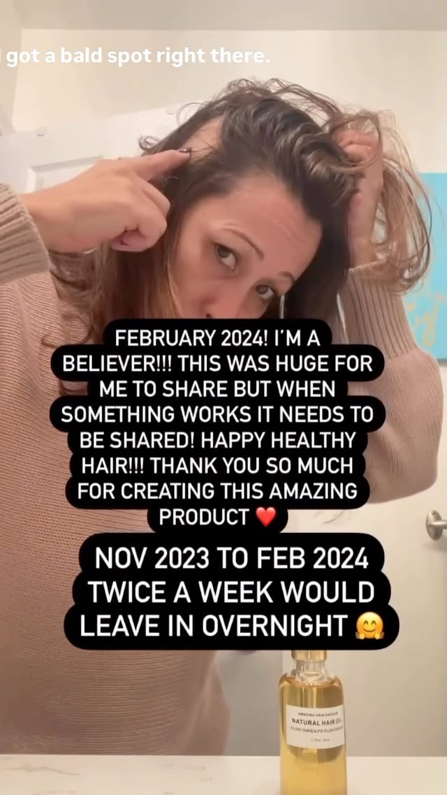 My client’s gorgeous journey ❤️
Her bald spot filled in completely later and also, her premenopausal hair results are incredible 😘
Let’s get growing
#Hairgrowth #hairlosstreatment #hairgrowthoil #beforeandafter #hairtransformation #alopecia #alopeciaareata