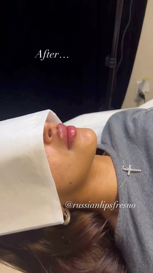 100% Customized Russian Lip Filler💋
What do you think of this customized pout.🥰
❌No Filter, Raw Process and Results😍
*Swelling will go down within the next few days
*Healing process is 2 weeks
Russian Lip Fillers💉
@russianlipsfresno
100% Customized based on each client’s desired outcome.
Thank you to our beautiful client for giving consent to share❤️
📲To book an appointment: DM US with your Full Name, Service and Phone #
🖤NYC - Open
🖤Fresno - February Sold Out
🖤Los Angeles - Waitlist
✔️Book in Advance to avoid disappointment💋