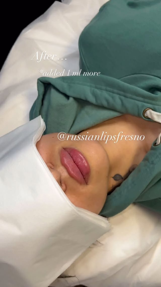 100% Customized Russian Lip Filler💋
What do you think of this customized pout.🥰
❌No Filter, Raw Process and Results😍
*Swelling will go down within the next few days
*Healing process is 2 weeks
Russian Lip Fillers💉
@russianlipsfresno
100% Customized based on each client’s desired outcome.
Thank you to our beautiful client for giving consent to share❤️
📲To book an appointment: DM US with your Full Name, Service and Phone #
🖤NYC - Open
🖤Fresno - March 23 -25
🖤Los Angeles - Waitlist
✔️Book in Advance to avoid disappointment💋