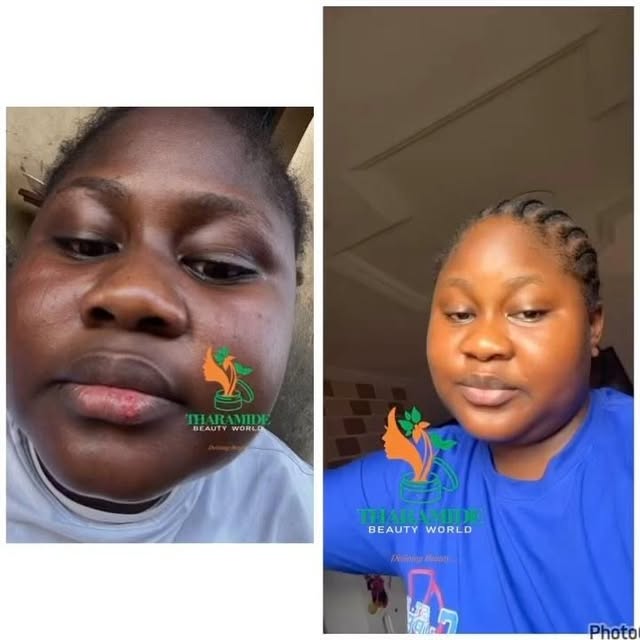 @tharamide_beauty_world a skincare brand that helps to restore your skin confidence by repairing, treat skin issues, maintain complexion and make your skin look flawless. Our products are safe yet effectiveโฆ. Join the no filter gang nowโฆ. @ayam_pikoh_official happy with her skinโฆ.
Products used : Glow perfect kit
Send a Dm for recommendation or click the link in bio
#skin#routine#flawless#cloth#jewerly#hair#biggirls#scrub#skinrepair#lookinggood#bestplug#business#