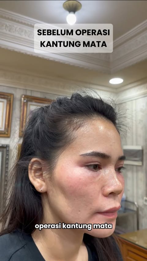 Pasien kami sudah membuktikan sendiri hasil dari Operasi Kantung Mata di Queen Plastic Surgery!
✨ Kini tampil lebih muda, segar, dan percaya diri tanpa kantung mata yang mengganggu.
Hasilnya? Puas banget dan natural!
Kalau kamu punya masalah serupa — mata lelah, kendur, atau tampak tua sebelum waktunya — ini saatnya ambil langkah!
💬 Konsultasi GRATIS & lihat sendiri hasil nyatanya!
#TestimoniQueenPlasticSurgery #OperasiKantungMata #KantungMataHilang #QueenPlasticSurgery #MataSegarMuda #BedahPlastikJakarta #KlinikKecantikanJakarta #EyelidSurgeryJakarta #BlepharoplastyJakarta #PasienPuas #TestimoniJujur #WajahLebihMuda #KlinikEstetikTerbaik #CTAOperasiKantungMata #solusimatakendur
