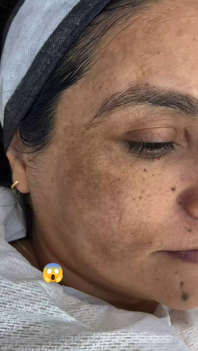 Book your glow session today:
8750235045 | 8826867065 | 8368468571 | 8882725710
.
Advanced Herbal Skin Treatment :
The one stop destination for lightening & clear skin ✅
Lasting Impression Aesthetics
Our Herbal Skin Treatment is 100% Safe!
❌No side effects!!
Get rid of :
Cystic Acne
Atrophic Scars
Deep Scars
Pigmentation
Dark circles
Acne spots
Dull skin
Tan skin
Dark skin
Loose skin
Melasma spots
Blemish
One time treatment!
No multiple sitting required. It's Permanent skin lightening
#microblading #microbladingeyebrows #permanentmakeup #permanentmakeupartist #permamentmakeupclass #permanentmakeuptraining