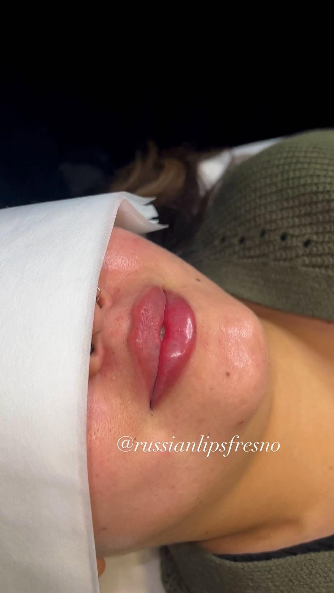 100% Customized Russian Lip Filler💋
What do you think of this customized pout.🥰
❌No Filter, Raw Process and Results😍
*Swelling will go down within the next few days
*Healing process is 2 weeks
Russian Lip Fillers💉
@russianlipsfresno
100% Customized based on each client’s desired outcome.
Thank you to our beautiful client for giving consent to share❤️
📲To book an appointment: DM US with your Full Name, Service and Phone #
🖤NYC - Open
🖤Fresno - March 23-24
🖤Los Angeles - Waitlist
✔️Book in Advance to avoid disappointment💋