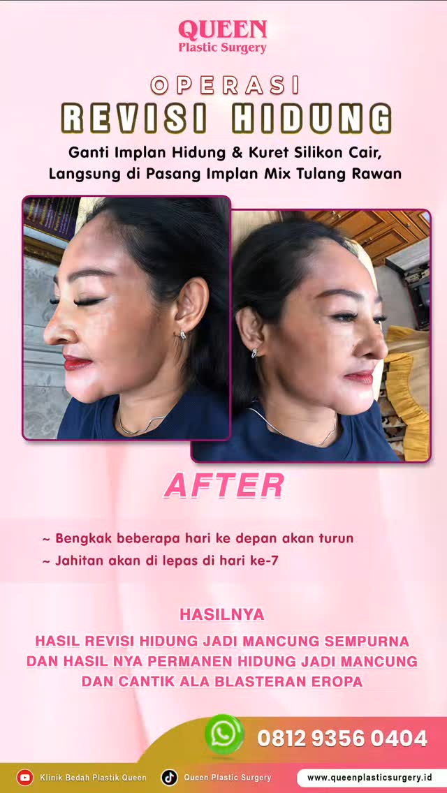👃Spill Hasil Rhinoplasty Asli dari Queen Plastic Surgery!
Bentuk hidung lebih mancung, proporsional, dan natural? YES, itu semua nyata setelah tindakan Rhinoplasty di Queen Plastic Surgery!
💫 Tanpa edit, tanpa filter – hasilnya benar-benar bikin percaya diri naik level!
Ditangani oleh dokter ahli bedah plastik berpengalaman, hasil terlihat alami & sesuai bentuk wajah.
✨ Wajah jadi lebih seimbang dan elegan hanya dengan satu tindakan!
💬 Yuk, konsultasi sekarang dan #SpillHasil cantikmu bareng kami!
#SpillRhinoplasty #RhinoplastyQueen #HasilOperasiHidung #OperasiHidungJakarta #QueenPlasticSurgery #BedahPlastikJakarta #RhinoplastyNatural #TransformasiWajah #RhinoplastyIndonesia #HidungMancungNatural #RhinoplastyBeforeAfter #KlinikKecantikanJakarta #SpillCantik #CTAOperasiHidung #klinikestetikterbaik