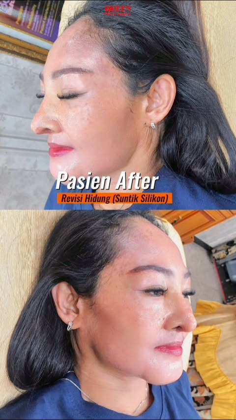 Masih Suntik Silikon & Tanam Benang? Think Again!
Banyak yang tergiur hasil instan dari suntik silikon dan tanam benang, padahal efek sampingnya bisa fatal dan bikin rugi! 😣
Daripada ambil risiko, lebih baik lakukan Rhinoplasty di Klinik Queen Plastic Surgery yang berizin resmi dan diawasi dokter ahli.
💎 Hasilnya alami, aman, dan tahan lama!
✨ Banyak pasien puas dan percaya karena kualitas & keamanan kami terbukti.
#StopSuntikSilikon #BahayaTanamBenang #RhinoplastyAman #OperasiHidungJakarta #KlinikQueenPlasticSurgery #BedahPlastikTerpercaya #RhinoplastyResmi #WajahCantikAman #TransformasiAman #OperasiHidungTerbaik #KlinikEstetikJakarta #RhinoplastyJakarta #JanganTertipuMurah #KonsultasiRhinoplasty #QueenPlasticSurgery