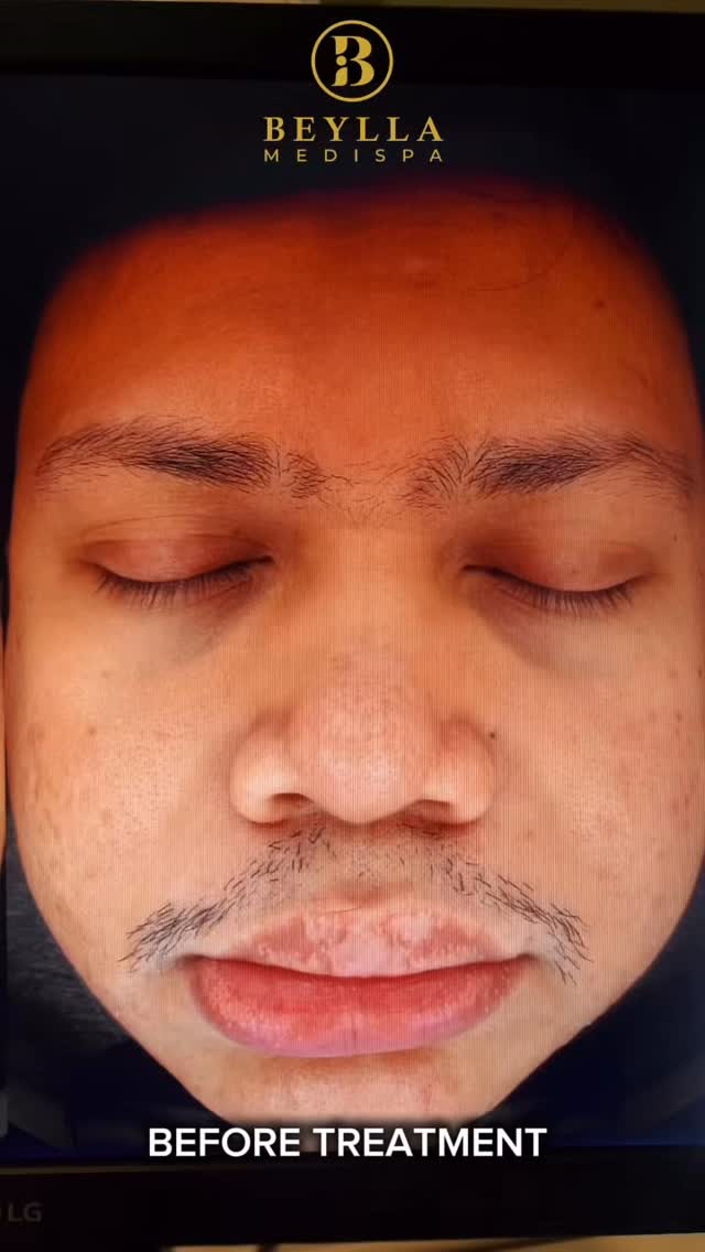 Dulu penuh parutโฆ sekarang kulit makin licin & bersih! โจ
Hasil lepas beberapa sesi rawatan di Beylla Medispa, parut jerawat makin pudar, tekstur kulit pun nampak lebih sekata dan sihat ๐
๐ธ no filter needed bila kulit dah cantik semula jadi ๐
Kalau korang ada masalah parut degil, this is the sign untuk mulakan rawatan sekarang ๐ฏ
#BeyllaMedispa #KulitCantik #ParutJerawatPudar #BeforeAfterReal #ChemicalPeelResult #SpaPilihanRamai #GlowingSkinJourney #TestimoniPelanggan #RawatanKulitBerhasil