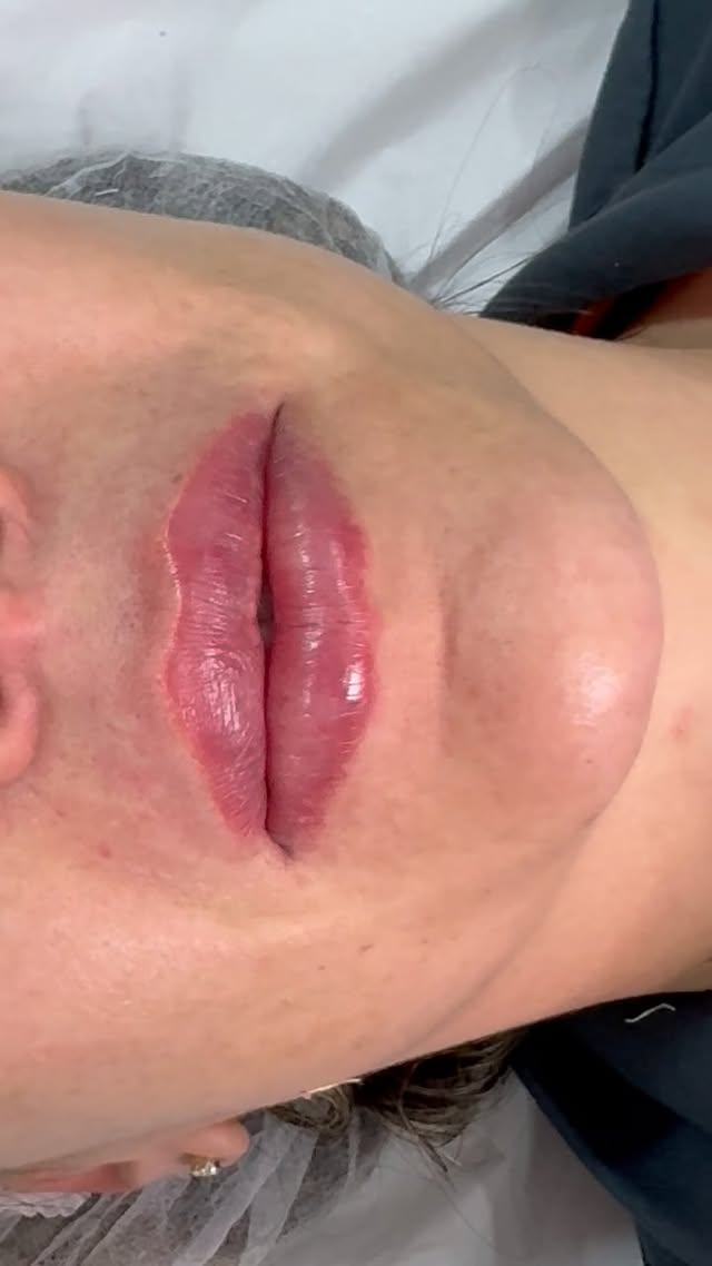 Medo de fazer preenchimento Labial?????
Olha esse depoimento da nossa cliente🙈💕
Agende sua avaliação e venha realizar seu procedimento. ✨
