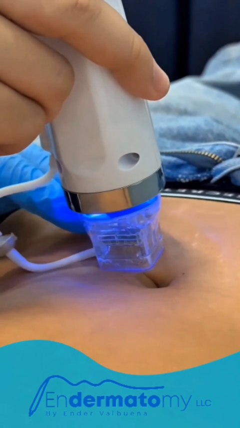 🟦¿Piel apagada o con arrugas? En Endermatomy, la radiofrecuencia fraccionada estimula colágeno, mejora firmeza, textura y rejuvenece desde la primera sesión. Es segura, no invasiva y con resultados visibles. Redescubre tu piel con tecnología estética avanzada. Agenda hoy. Endermatomy, salud y belleza que se sienten... y se notan.
☎️ Agenda tu cita 786-930.0904
#piel #agenda #tratamiento #skincare