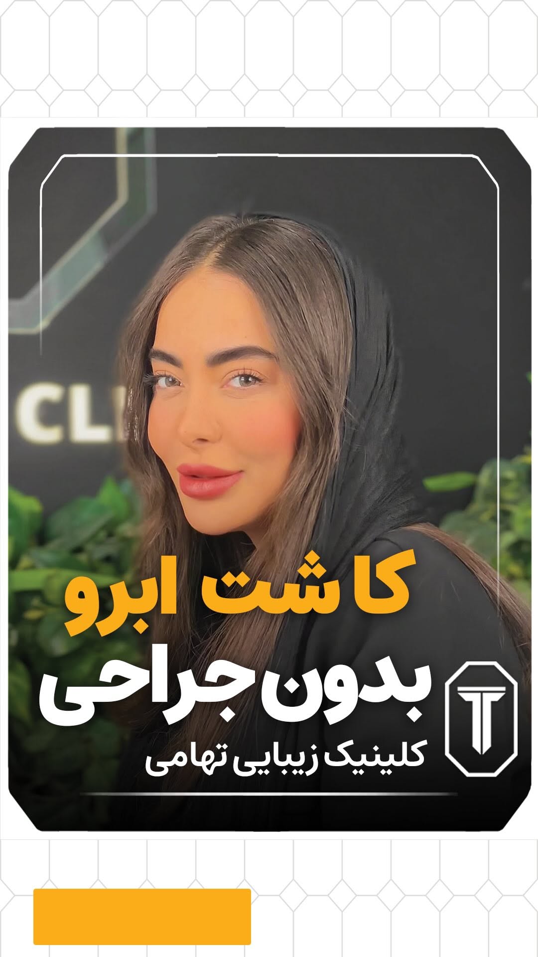 ✨ کاشت ابرو بدون جراحی، بدون برش، بدون خونریزی!
زیبایی طبیعی بدون دردسر، با تکنیک روز دنیا ✅
📍 مشاوره رایگان | نتیجهای کاملاً طبیعی
📍 آدرس: تهران، جردن
📞 مشاوره و نوبتدهی:09124057701 | 71031-021
#کاشت #کاشت_ابرو #کاشت_ابروی_طبیعی #کاشت_بدون_جراحی