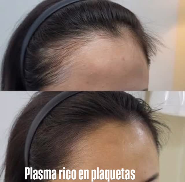 🔬 ¿Qué es el PRP?
Es un preparado que se obtiene de tu propia sangre. Se extrae una muestra, se centrifuga para separar las plaquetas del resto de los componentes, y se inyecta en el cuero cabelludo.
🧪 ¿Por qué ayuda al cabello?
Las plaquetas contienen factores de crecimiento, que son proteínas que estimulan:
La regeneración celular
El aumento del flujo sanguíneo en los folículos
El despertar de folículos inactivos, lo que favorece el crecimiento del cabello
✅ Beneficios:
Puede fortalecer el cabello debilitado
Disminuye la caída
Estimula el crecimiento de cabello nuevo en zonas donde aún hay folículos vivos
⚠️ Importante:
Funciona mejor en personas con alopecia androgénica incipiente (es decir, caída no avanzada)
No es un milagro: requiere varias sesiones y mantenimiento
Siempre debe aplicarlo un profesional