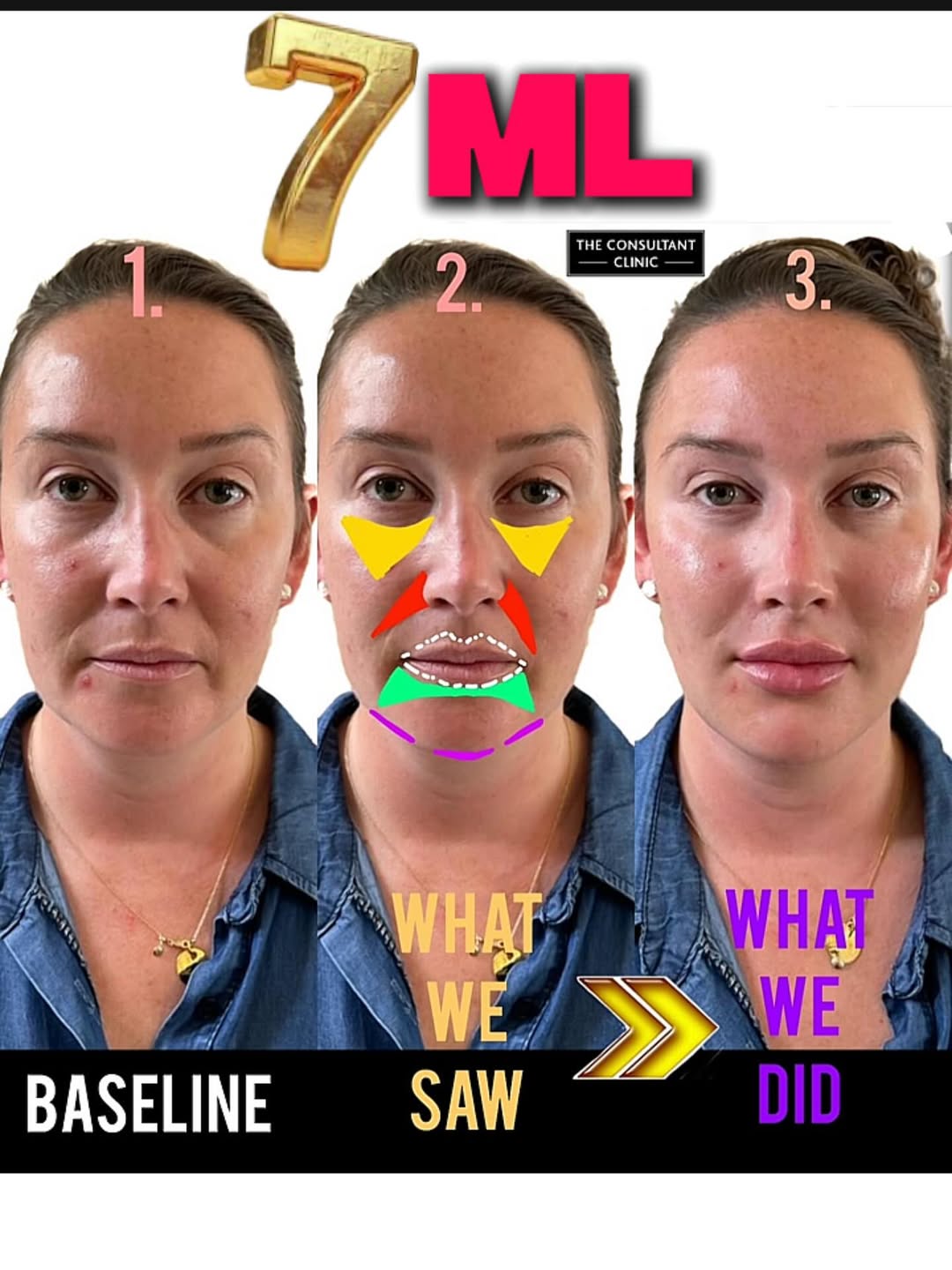 Let’s be honest. Really honest.
If you hadn’t seen the baseline photo, would you have guessed she’d had filler? We doubt it.
Her friends would probably say:
✨ “You look glowy today!”
✨ “New skincare?”
✨ “Must’ve been the healthcare kick / promotion / new man!”
…when in fact, it was a little help from someone who understands anatomy, proportion, and restraint.
This is high-level aesthetic work—where the injector has taste, training, and a terrifying attention to detail.
We call it Full Facial Rejuvenation (FFR), and here’s what it included:
• Anterior midface
• Pyriform & gonial angles
• Pogonion (chin projection)
• Lip augmentation
• Liquid rhinoplasty
It’s not about chasing volume—it’s about restoring harmony. That’s why you don’t see the filler.
You just see a fresher, more balanced version of her.
⸻
✨ MEDICAL PROFESSIONAL?
We also run an accredited training academy, open exclusively to medical professionals. No cowboys, no corner shops—just advanced education with the standards this industry should demand.
⸻
✨ READY TO BOOK?
You’ll find us in:
🇬🇧 England: Liverpool, Manchester, Leeds, Birmingham, Bristol, Harley Street (London)
🇬🇧 Scotland: Glasgow
🇮🇪 Ireland: Belfast & Dublin
🇫🇷 France: Paris
🇦🇪 UAE: Dubai
🇦🇺 Australia: Melbourne
🇺🇸 USA: Beverly Hills, Napa Valley (CA), Manhattan (NYC), Miami, Las Vegas, Dallas – and Chicago opens next month!
Click the link in our bio to book with one of our world-class doctors.