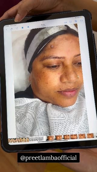 ☎️8750235045
8826867065
Advanced Herbal Skin Treatment :
The one stop destination for lightening & clear skin ✅
Lasting Impression Aesthetics
Our Herbal Skin Treatment is 100% Safe!
❌No side effects!!
Get rid of :
Cystic Acne
Atrophic Scars
Deep Scars
Pigmentation
Dark circles
Acne spots
Dull skin
Tan skin
Dark skin
Loose skin
Melasma spots
Blemish
One time treatment!
No multiple sitting required. It's Permanent skin lightening
DM for more details/ Book your seat on 7678683658
#microblading #microbladingeyebrows #permanentmakeup #permanentmakeupartist #permamentmakeupclass #permanentmakeuptraining #permanentmakeupacademydelhi #permanentmakeupacademy #permanentmakeupindia #bbglow #bbglowdelhi #hydrafaci̇al