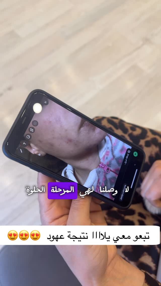 علاج #اثار #الحبوب و #التصبغات 🔥🔥🔥بأفضل التقينات العالمية والأجهزة المضمونة لعلاج الحبوب والآثار .. اليوم معكم بتجربة حية لمرحلة علاج كامل لمتابعة ادينا ..شكرا لكل صبية بتشاركنا تجربتها في مركز جودي #علاج_الحفر #البيوزوم #اكسزوم #تصبغات