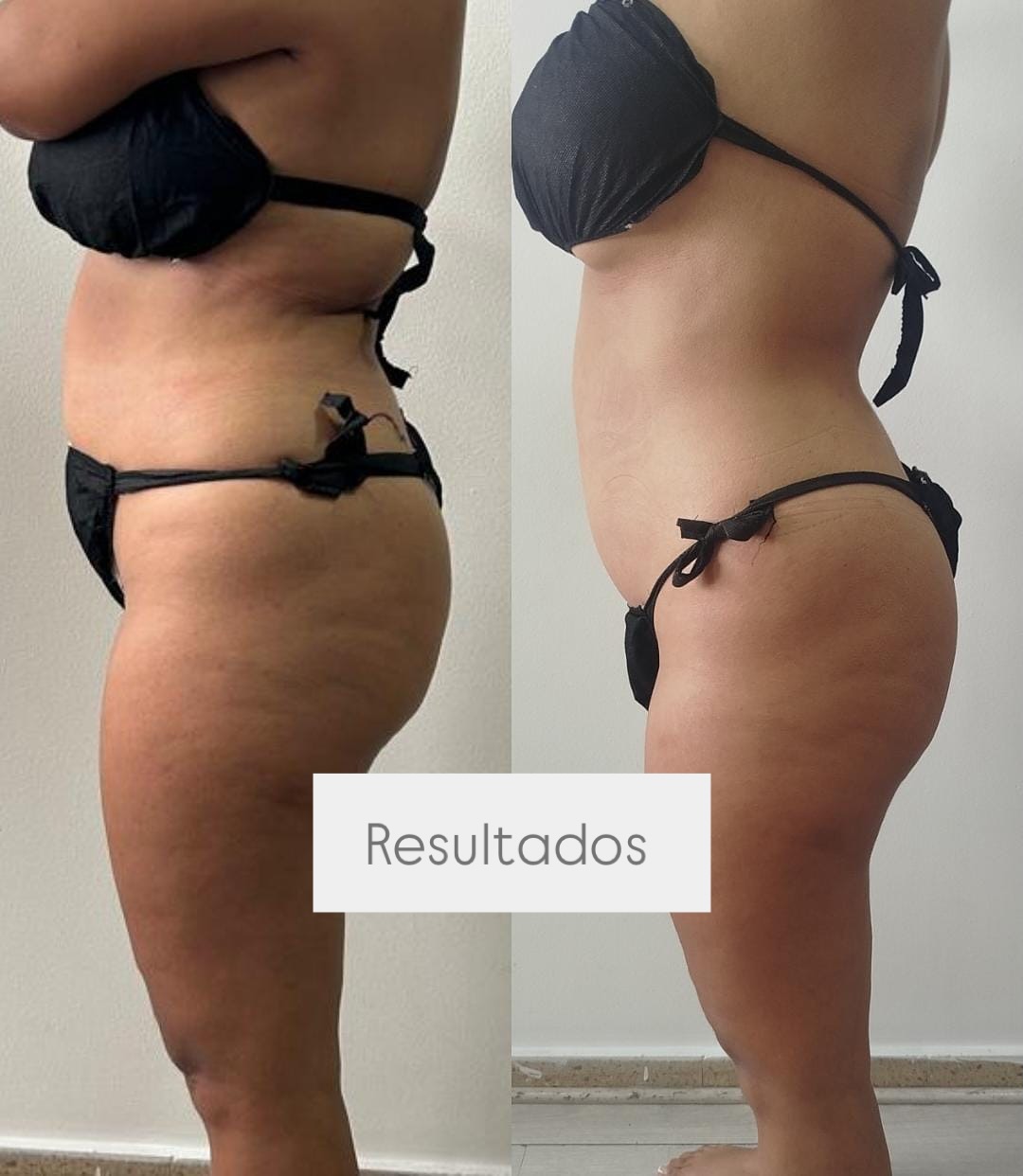 Tratamiento completo con
✅Hidrolipoclasia
✅Masajes
✅aparatología
✅Drenantes