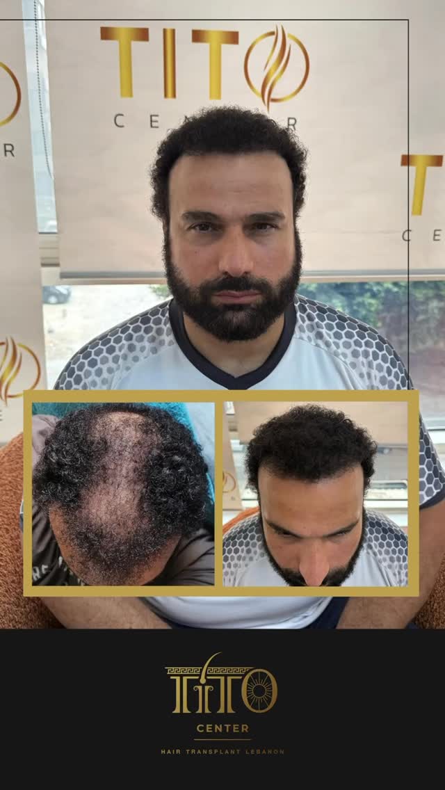 تقنية اليوم… نتائج تدوم لعمر.
في تيتو، نستخدم أجهزة متطورة وتقنيات عالمية لزراعة الشعر الطبيعي بأعلى دقة.
كل خطوة محسوبة، وكل نتيجة موثقة بشهادة رسمية.
مش مجرد زراعة… هذا استثمار في مظهرك.
Today’s tech, results that last.
At Tito, we use world-class technology and precision tools for natural hair transplants that look and stay real.
Every step is calculated. Every result certified.
#Titocenter #HairTech #HairTransplant #AdvancedTechnology #NaturalHair #HairRestoration #CertifiedResults #HairClinicExperts